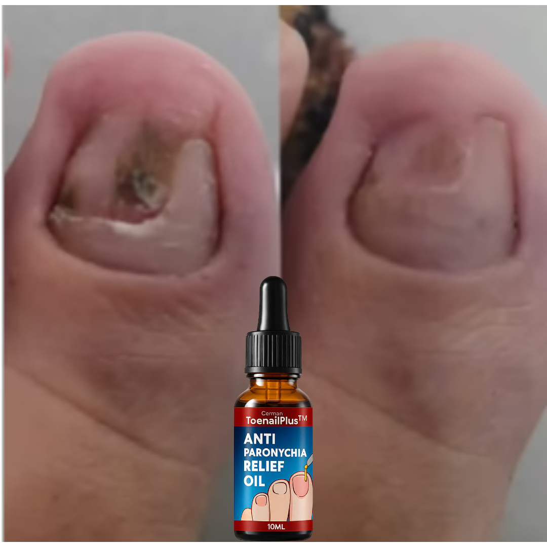 ANTY PARONYCHIA RELIEF OIL – Tratamiento rápido antifúngico para uñas Premium  compra 1 te regalamos el OTRO 2 X 1 APROVECHA!